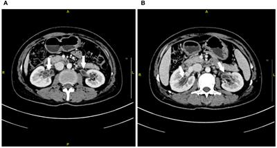 Case report: Urothelial injury in a female with breast cancer: a rare adverse event after the combination of paclitaxel and trastuzumab